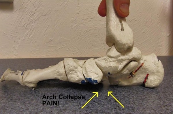 Pronation + arch collapse - side